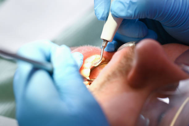 Best Root Canal Emergency Dentist  in Charles City, IA