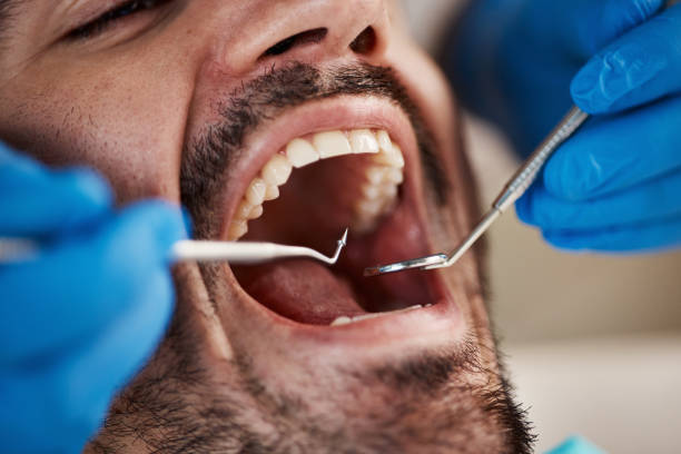 Teeth Whitening in IA