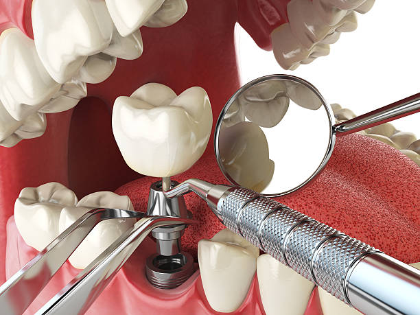 Best Urgent Tooth Repair  in Charles City, IA